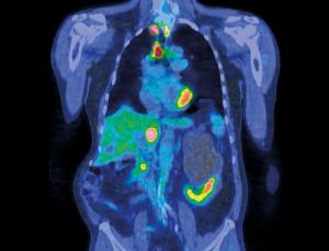 Giant leaps of evolution make cancer cells deadly