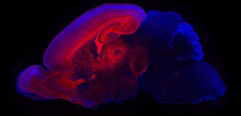 Scientists find mechanism for altered pattern of brain growth in autism spectrum disorder