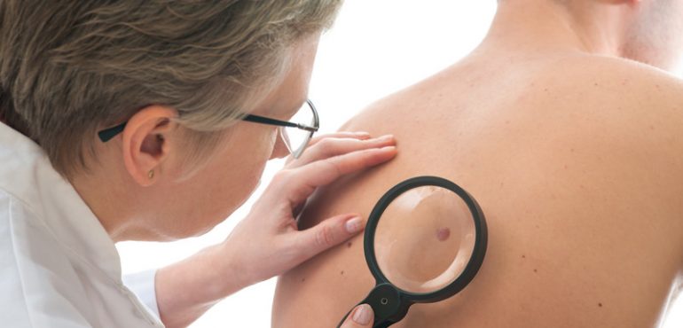 Promising new drug stops spread of melanoma by 90 percent
