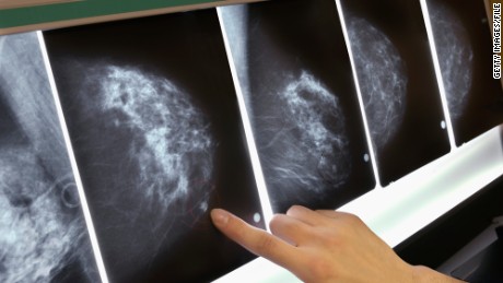 Breast cancer genetics revealed: 72 new mutations discovered in global study