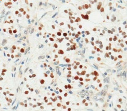 Discovery of kidney cancer driver could lead to new treatment strategy