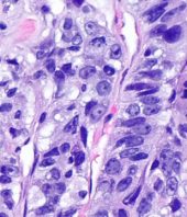 A Clever New Strategy for Treating Cancer, Thanks to Darwin