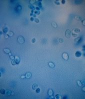 A Mysterious Infection, Spanning the Globe in a Climate of Secrecy