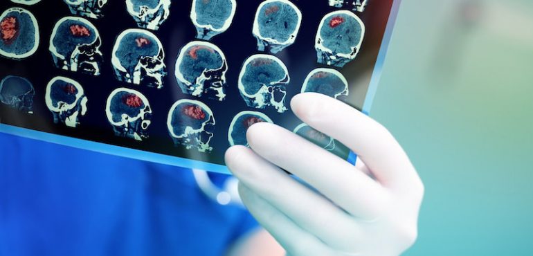 Scientists find ally in fight against brain tumors: Ebola